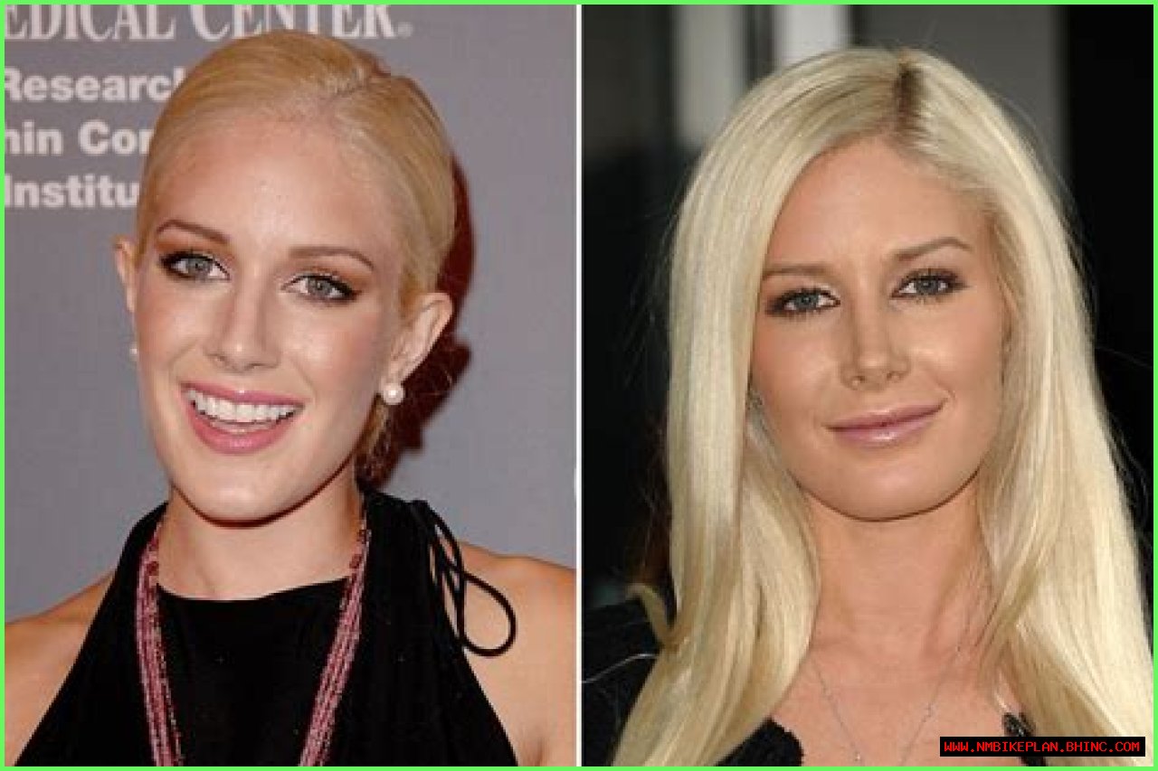 Heidi Montag Before and After Surgery: Navigating the Reality TV Star’s Transformation
